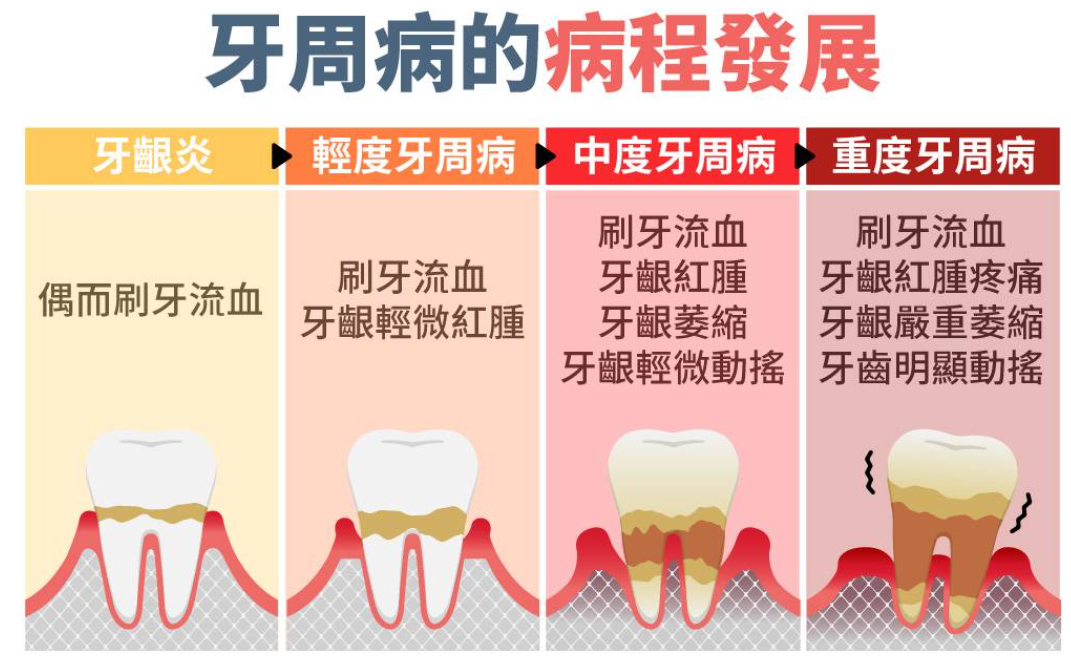 牙周病的病程發展 牙周病的病程發展