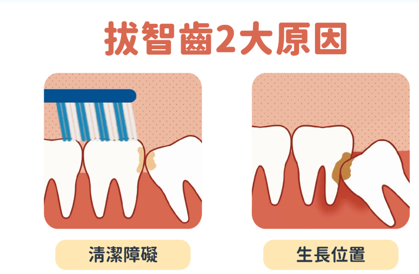 拔智齒的兩大原因