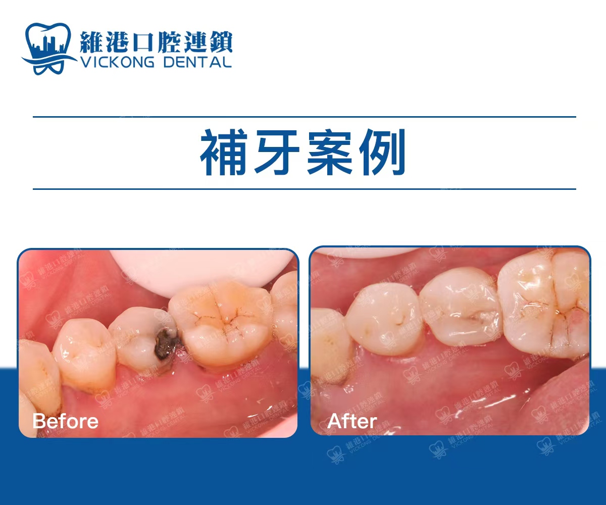 深圳維港口腔補牙案例 深圳維港口腔補牙案例