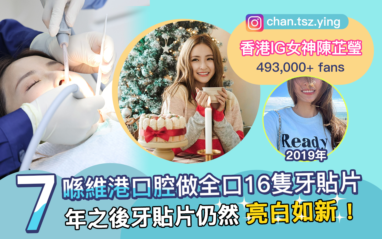 深圳维港口腔牙贴面 深圳维港口腔牙贴面