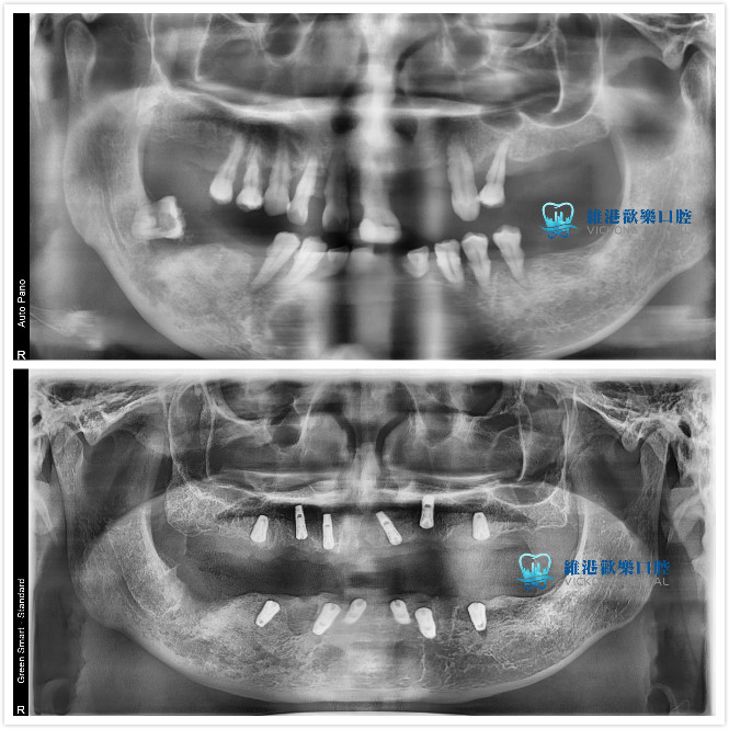 深圳維港歡樂口腔-謝立華主治醫生all-on-6種植牙案例