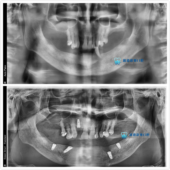 深圳維港歡樂口腔-謝立華主治醫生all-on-4種牙案例