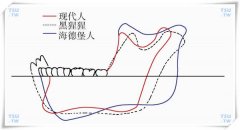 為什麼有些人會長阻生智齒？