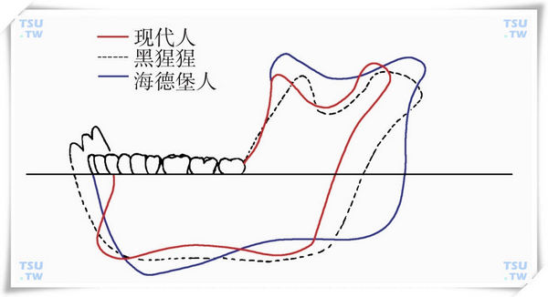 頜骨變化-深圳拔智齒