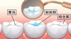 【深圳牙科科普】窩溝封閉劑是什麼成分？對小孩牙齒有害嗎？