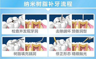 深圳樹脂補牙