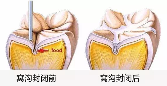 深圳窩溝封閉
