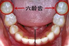 什麼是“六齡齒”？為什麼容易蛀牙？