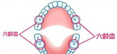 “六齡齒”會阻生嗎，怎麼辦？
