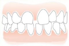 孩子新換的門牙有縫怎麼辦？