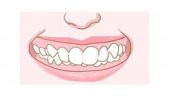 兒童什麼時候矯正牙齒比較好？