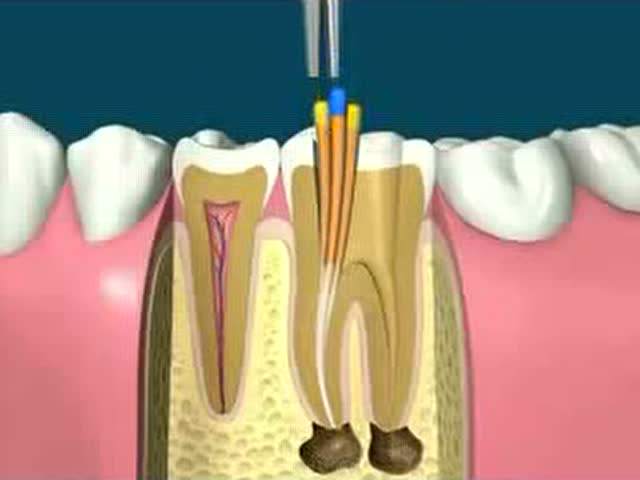 根管治療
